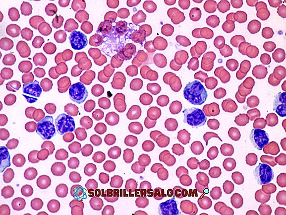 Leukocytose (høye leukocytter): symptomer, årsaker, behandlinger