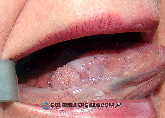 Лилав език: симптоми, причини и лечение